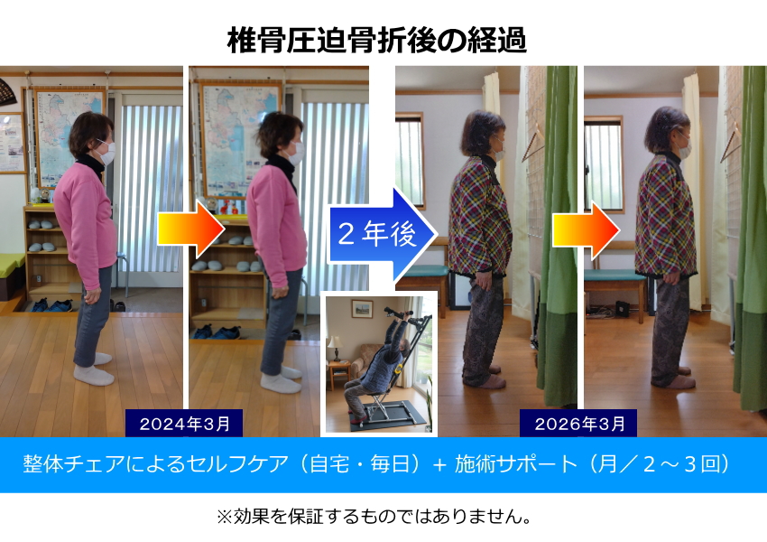 椎骨圧迫骨折後の経過・2年後・整体チェアによるセルフケア(自宅・毎日)+施術サポート(月/2~3回)